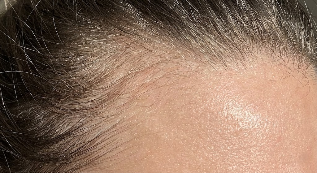 Macro photography showing new baby hairs growing along the hairline, signaling recovery from telogen effluvium
