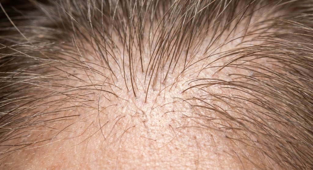 Macro photography showing new baby hairs sprouting on the scalp